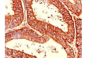 Immunohistochemistry of paraffin-embedded human endometrial cancer using ABIN7174480 at dilution of 1:100 (CDC34 anticorps  (AA 1-236))