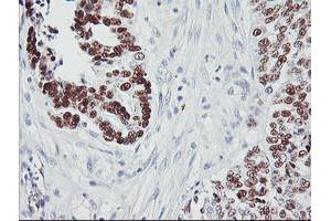 Immunohistochemical staining of paraffin-embedded Adenocarcinoma of Human ovary tissue using anti-TP53 mouse monoclonal antibody. (p53 anticorps)