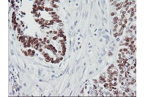 Immunohistochemical staining of paraffin-embedded Adenocarcinoma of Human ovary tissue using anti-TP53 mouse monoclonal antibody. (p53 anticorps)