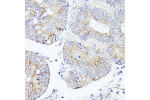 Immunohistochemistry of paraffin-embedded human colon carcinoma using ATG5 antibody. (ATG5 anticorps  (AA 1-275))