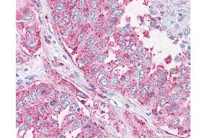 Anti-NEK6 antibody IHC of human Lung, Non-Small Cell Carcinoma. (NEK6 anticorps  (N-Term))