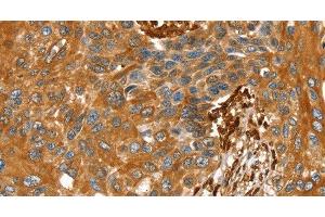 Immunohistochemistry of paraffin-embedded Human esophagus cancer tissue using TAGLN Polyclonal Antibody at dilution 1:30 (Transgelin anticorps)