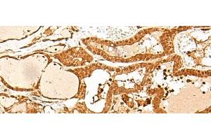 Immunohistochemistry of paraffin-embedded Human thyroid cancer tissue using GTF3C3 Polyclonal Antibody at dilution of 1:30(x200) (GTF3C3 anticorps)