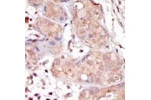 Formalin-fixed and paraffin-embedded human cancer tissue reacted with the primary antibody, which was peroxidase-conjugated to the secondary antibody, followed by DAB staining.