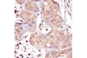 Formalin-fixed and paraffin-embedded human cancer tissue reacted with the primary antibody, which was peroxidase-conjugated to the secondary antibody, followed by DAB staining. (MAK anticorps  (C-Term))