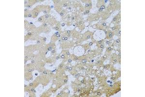 Immunohistochemistry of paraffin-embedded human liver injury using UQCR10 antibody at dilution of 1:100 (x40 lens). (UQCR10 anticorps)