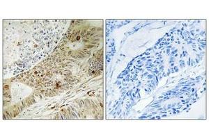 Immunohistochemistry analysis of paraffin-embedded human colon carcinoma tissue, using ATRIP (Phospho-Ser224) antibody.