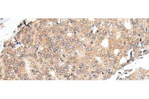 Immunohistochemistry of paraffin-embedded Human prost at e cancer tissue using PRELID1 Polyclonal Antibody at dilution of 1:40(x200)