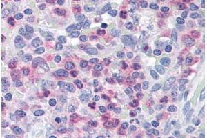Human Spleen (formalin-fixed, paraffin-embedded) stained with UNC13D antibody ABIN290188 at 2. (UNC13D anticorps  (AA 1079-1090))