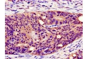 Immunohistochemistry of paraffin-embedded human colon cancer using ABIN7162886 at dilution of 1:100