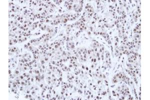 IHC-P Image Immunohistochemical analysis of paraffin-embedded A549 Xenograft, using HNF-1 alpha, antibody at 1:100 dilution. (HNF1A anticorps)