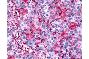 Anti-CELSR1 antibody IHC of human Breast, Carcinoma. (CELSR1 anticorps  (N-Term))