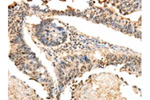 The image on the left is immunohistochemistry of paraffin-embedded Human colon cancer tissue using ABIN7130100(LRP12 Antibody) at dilution 1/25, on the right is treated with fusion protein. (LRP12 anticorps)