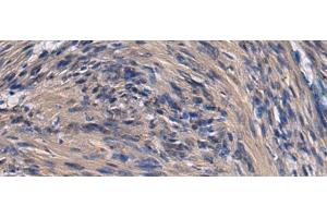 Immunohistochemistry of paraffin-embedded Human brain tissue using ICA1 Polyclonal Antibody at dilution of 1:70(x200) (ICA1 anticorps)