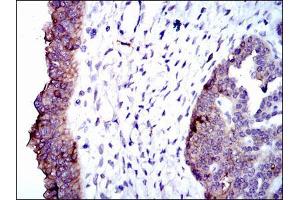 Immunohistochemical analysis of paraffin-embedded ovarian cancer tissues using ALPL mouse mAb with DAB staining.