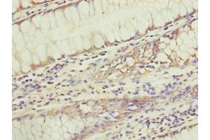 Immunohistochemistry of paraffin-embedded human colon cancer using ABIN7159945 at dilution of 1:100 (KIAA0391 anticorps  (Catalytic Subunit))