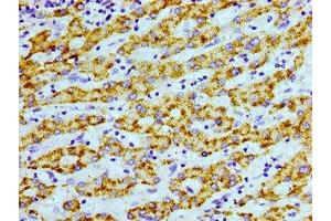 Immunohistochemistry of paraffin-embedded human liver cancer using ABIN7168945 at dilution of 1:100 (AGXT anticorps  (AA 112-294))