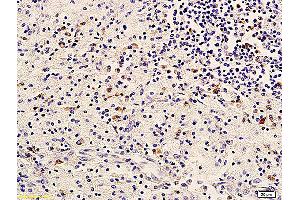 Formalin-fixed and paraffin embedded human cervical carcinoma labeled with Anti-ErbB-3/HER3 Polyclonal Antibody, Unconjugated (ABIN686767) followed by conjugation to the secondary antibody and DAB staining