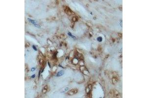Immunohistochemical analysis of 4EBP1 staining in human prostate cancer formalin fixed paraffin embedded tissue section. (eIF4EBP1 anticorps  (N-Term))