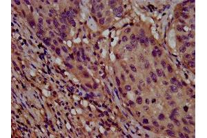 IHC image of ABIN7147931 diluted at 1:800 and staining in paraffin-embedded human lung cancer performed on a Leica BondTM system.