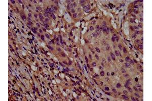 IHC image of ABIN7147931 diluted at 1:800 and staining in paraffin-embedded human lung cancer performed on a Leica BondTM system. (CLPTM1L anticorps  (AA 32-172))