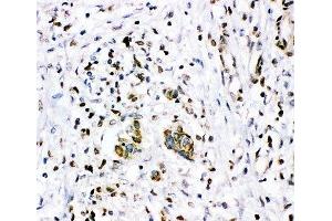 IHC-P: Glucocorticoid receptor antibody testing of human breast cancer tissue