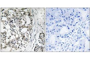 Immunohistochemistry analysis of paraffin-embedded human breast carcinoma tissue using PEX14 antibody. (PEX14 anticorps  (Internal Region))