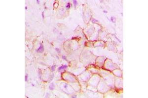 Immunohistochemical analysis of CD143 staining in human breast cancer formalin fixed paraffin embedded tissue section. (Angiotensin I Converting Enzyme 1 anticorps  (Center))