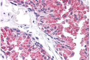 Human Prostate (formalin-fixed, paraffin-embedded) stained with TBC1D1 antibody ABIN213991 at 5 ug/ml followed by biotinylated goat anti-rabbit IgG secondary antibody ABIN481713, alkaline phosphatase-streptavidin and chromogen.