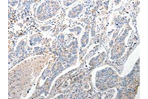 The image on the left is immunohistochemistry of paraffin-embedded Human lung cancer tissue using ABIN7190682(FOXD1 Antibody) at dilution 1/25, on the right is treated with synthetic peptide. (FOXD1 anticorps)