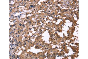 Immunohistochemistry of Human thyroid cancer using IL1A Polyclonal Antibody at dilution of 1:60 (IL1A anticorps)