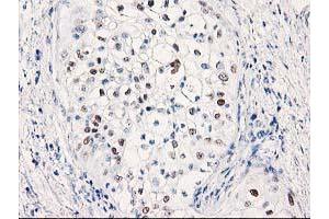 Immunohistochemical staining of paraffin-embedded Carcinoma of Human pancreas tissue using anti-TP53 mouse monoclonal antibody. (p53 anticorps)