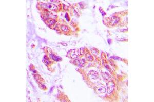 Immunohistochemical analysis of NGEP staining in human lung cancer formalin fixed paraffin embedded tissue section. (Anoctamin 7 anticorps  (C-Term))