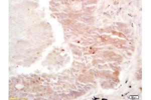 Formalin-fixed and paraffin embedded human lung carcinoma labeled with Rabbit Anti Cullin/C10orf46 Polyclonal Antibody, Unconjugated (ABIN670896) at 1:200 followed by conjugation to the secondary antibody and DAB staining (CACUL1 anticorps  (AA 181-248))