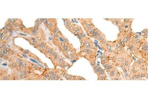 Immunohistochemistry of paraffin-embedded Human thyroid cancer tissue using CECR1 Polyclonal Antibody at dilution of 1:40(x200) (CECR1 anticorps)