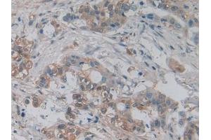 Detection of PKM2 in Human Pancreatic cancer Tissue using Polyclonal Antibody to Pyruvate kinase isozymes M2 (PKM2)