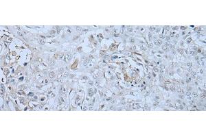 Immunohistochemistry of paraffin-embedded Human lung cancer tissue using HUWE1 Polyclonal Antibody at dilution of 1:30(x200) (HUWE1 anticorps)