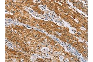 The image on the left is immunohistochemistry of paraffin-embedded Human gastic cancer tissue using ABIN7190211(CENPE Antibody) at dilution 1/50, on the right is treated with synthetic peptide.