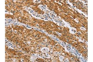 The image on the left is immunohistochemistry of paraffin-embedded Human gastic cancer tissue using ABIN7190211(CENPE Antibody) at dilution 1/50, on the right is treated with synthetic peptide. (CENPE anticorps)