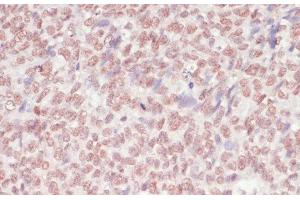 Immunohistochemistry of paraffin-embedded Human oophoroma using SNRNP70 Polyclonal Antibody at dilution of 1:100 (40x lens). (SNRNP70 anticorps)