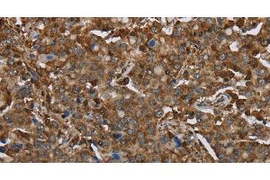 Immunohistochemistry of paraffin-embedded Human liver cancer using ARHGDIA Polyclonal Antibody at dilution of 1:30 (ARHGDIA anticorps)