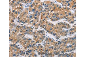 Immunohistochemistry of Human gastric cancer using CERK Polyclonal Antibody at dilution of 1:30 (CERK anticorps)