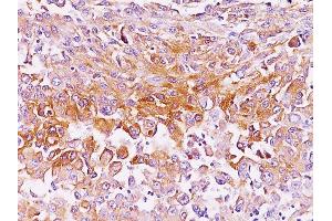 Formalin-fixed, paraffin-embedded human Melanoma stained with gp100 Monoclonal Antibody (SPM286). (Melanoma gp100 anticorps)