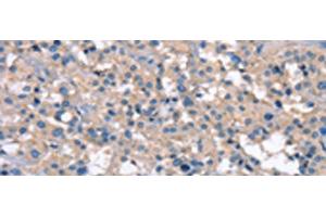 Immunohistochemistry of paraffin-embedded Human thyroid cancer tissue using ZFYVE16 Polyclonal Antibody at dilution of 1:60(x200) (ZFYVE16 anticorps)