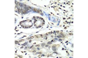Immunohistochemistry of paraffin-embedded human gastric cancer using HIF1AN antibody.