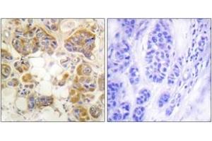 Immunohistochemistry analysis of paraffin-embedded human breast carcinoma tissue, using Collagen I Antibody. (Collagen Type I anticorps  (AA 1-50))