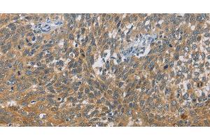 Immunohistochemistry of paraffin-embedded Human cervical cancer tissue using DIO1 Polyclonal Antibody at dilution 1:60