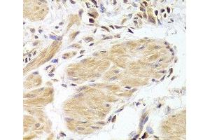 Immunohistochemistry of paraffin-embedded Human gastric cancer using Caspase-2 Polyclonal Antibody at dilution of 1:100 (40x lens). (Caspase 2 anticorps)