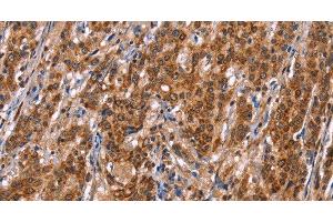Immunohistochemistry of paraffin-embedded Human gasrtic cancer tissue using TDP2 Polyclonal Antibody at dilution 1:40
