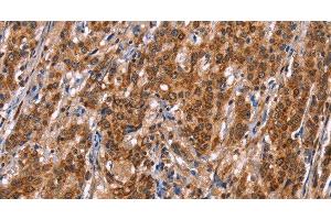 Immunohistochemistry of paraffin-embedded Human gasrtic cancer tissue using TDP2 Polyclonal Antibody at dilution 1:40 (TDP2 anticorps)